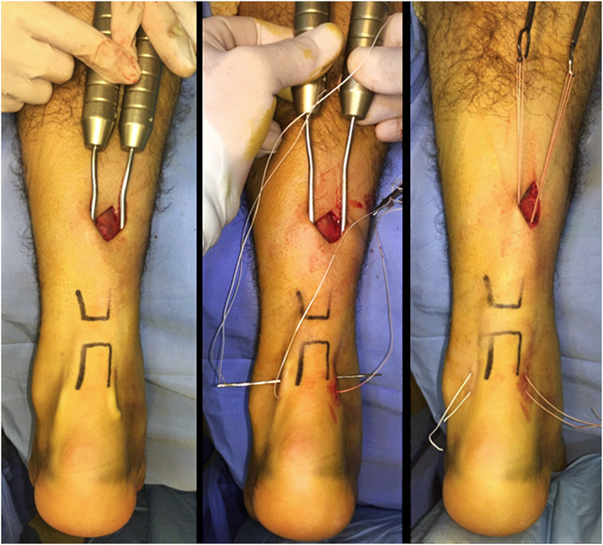 Rompimento do Tendão de Aquiles cirurgia