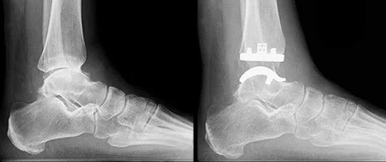 protese artrose do tornozelo