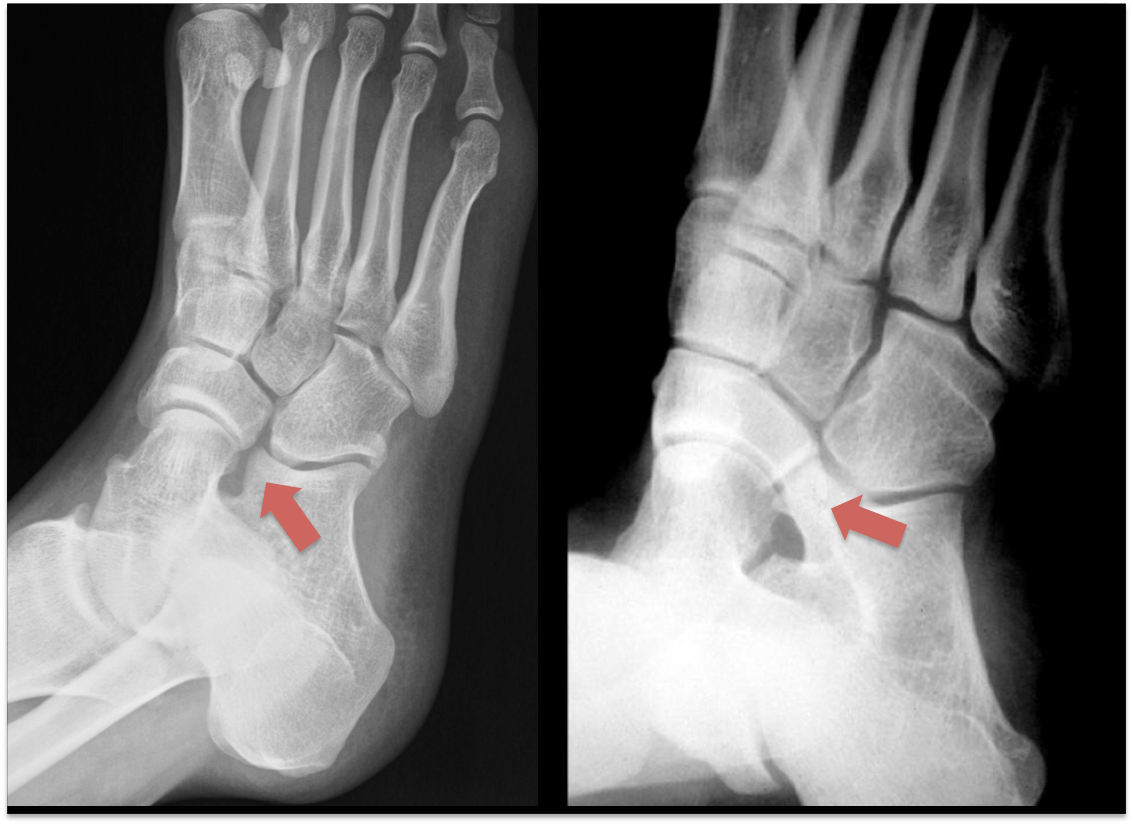 Coalizão tarsal: barra óssea