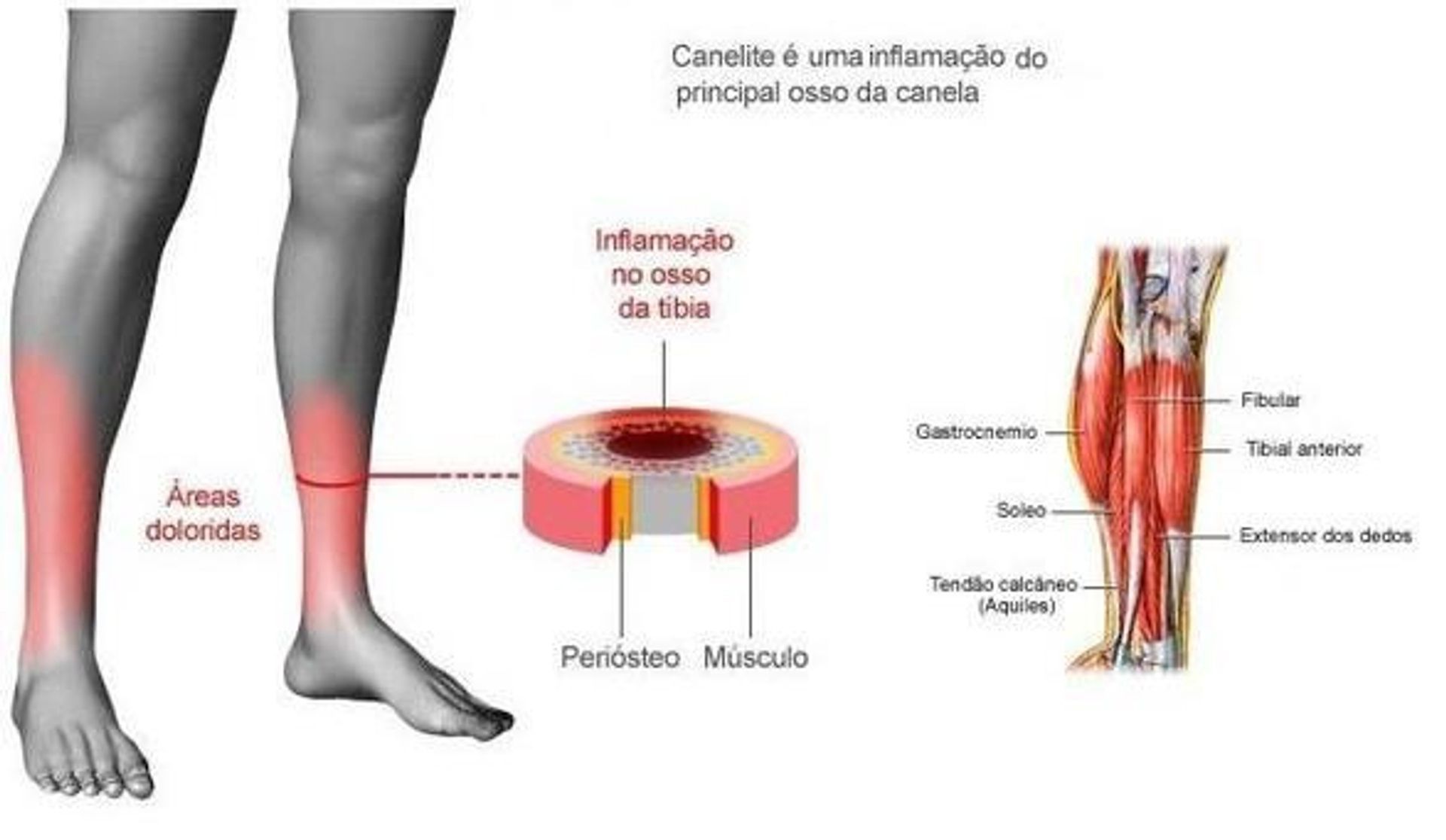 canelite