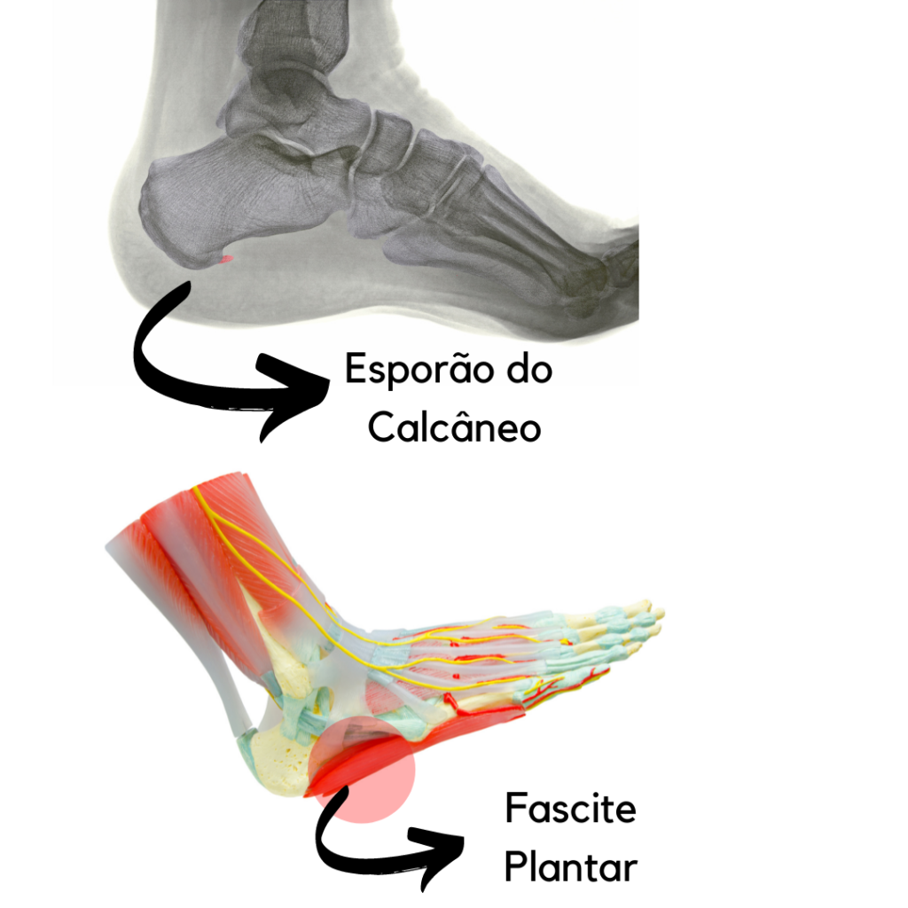 Diferença fascite plantar e esporao do calcaneo