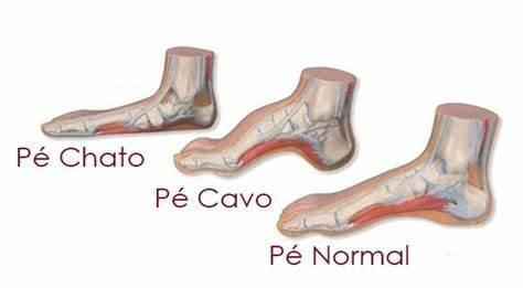 fascite plantar e esporao do calcaneo em pe chato e pe cavo