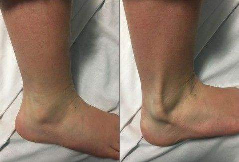 Tendinopatia dos tendões fibulares