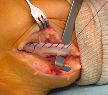 Tendinopatia dos tendões fibulares