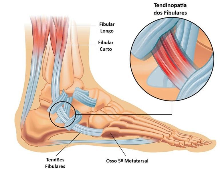 Tendinopatia dos tendões fibulares