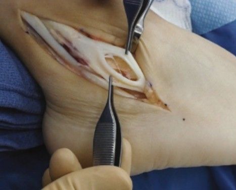 Tendinopatia dos tendões fibulares