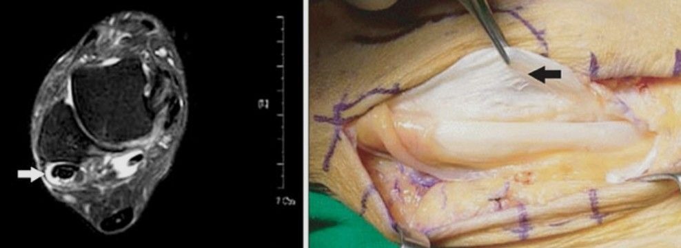 Tendinopatia dos tendões fibulares