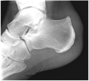 Sindrome de Haglund
