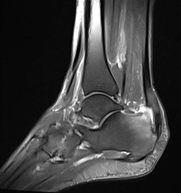 Sindrome de Haglund