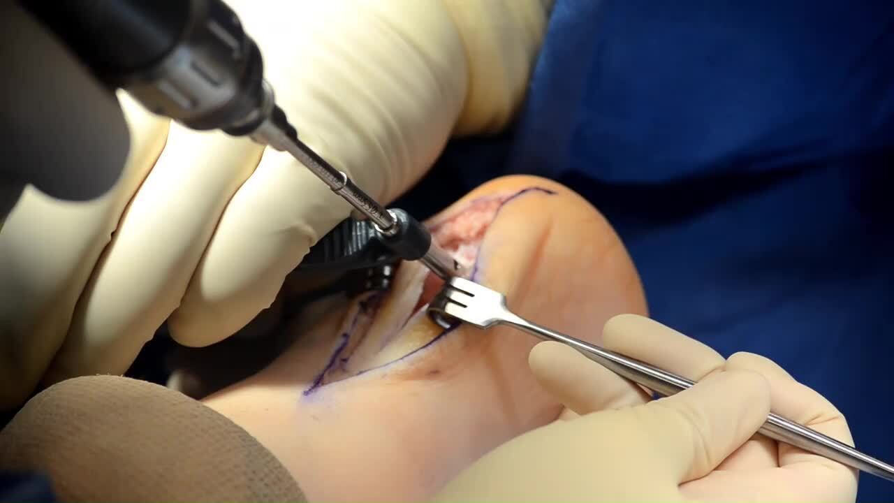 sindrome de haglund
