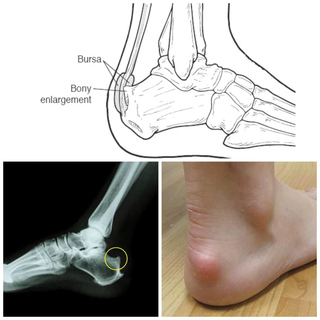 Sindrome de Haglund