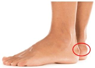 Sindrome de Haglund