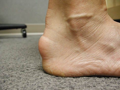 Sindrome de Haglund