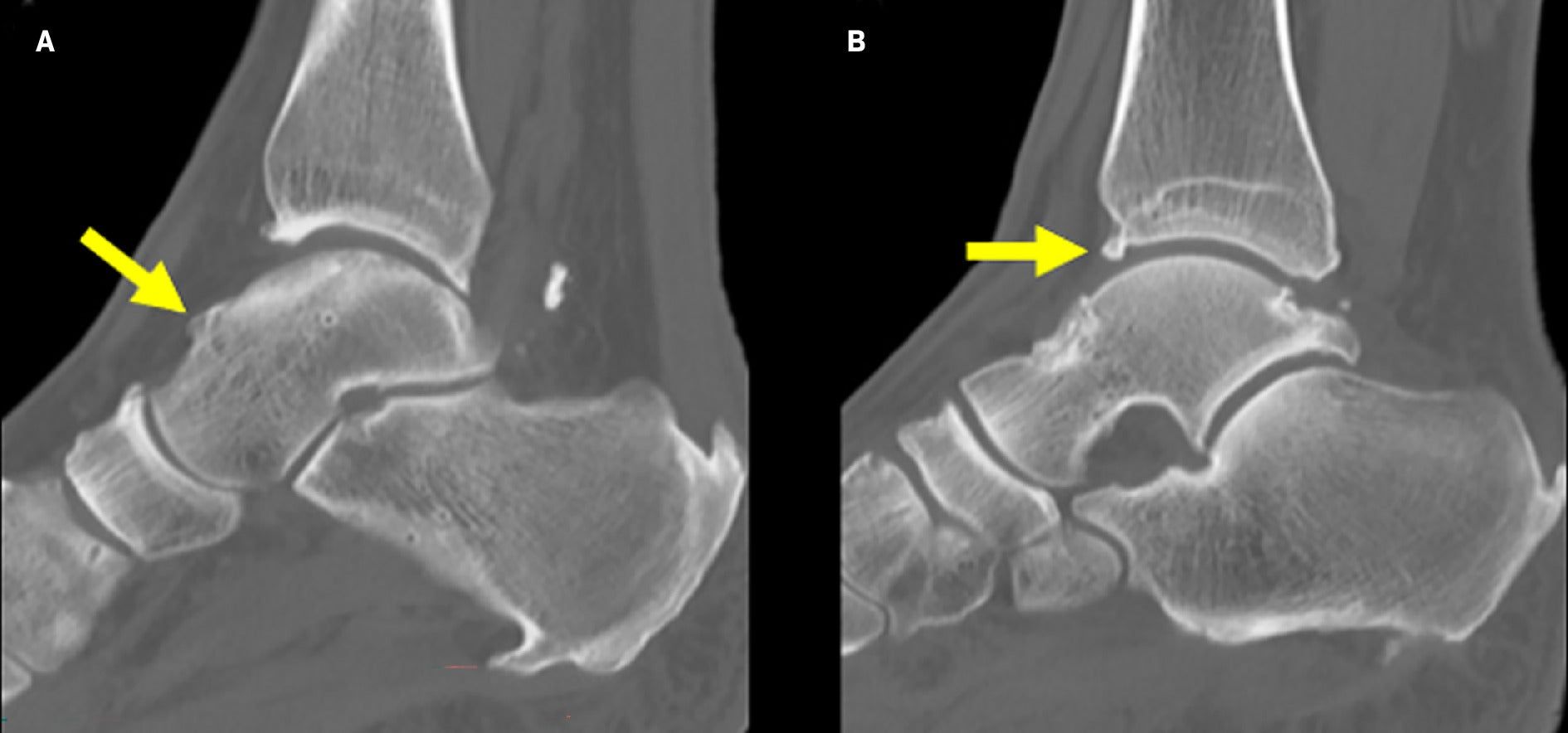 diagnóstico impacto anterior do tornozelo