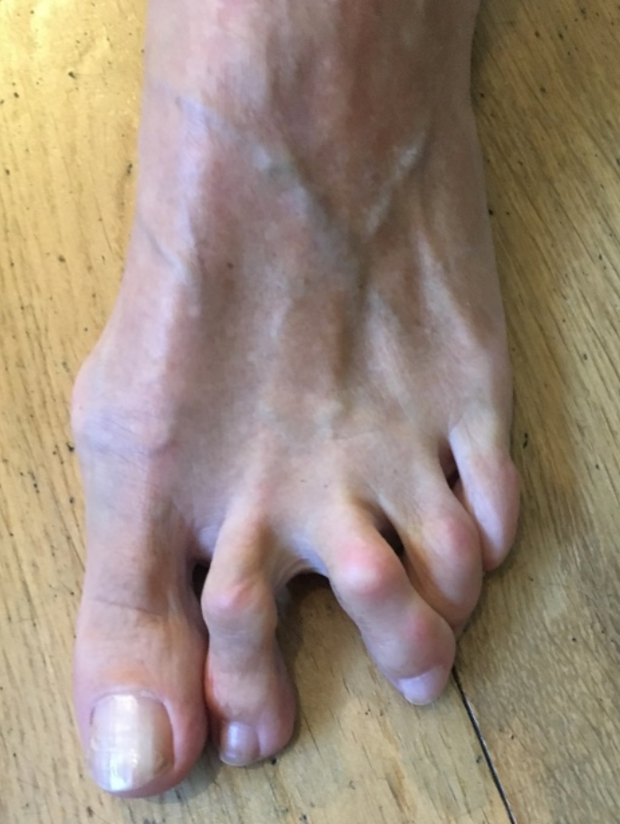 Lesão de placa plantar