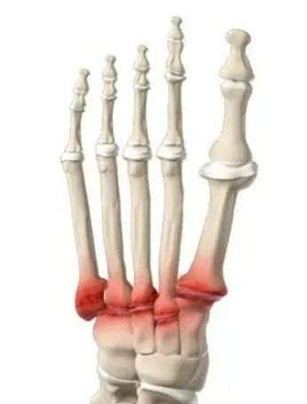 Artrose Tarso Metatarsal do pé