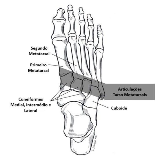 Artrose Tarso Metatarsal do pé