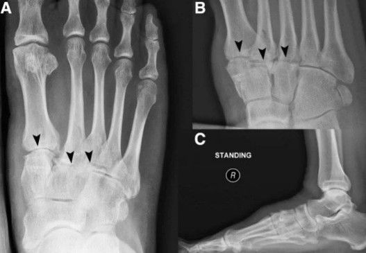 Artrose Tarso Metatarsal do pé