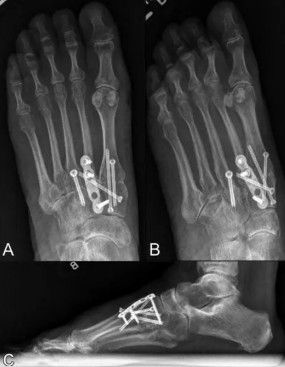 Artrose Tarso Metatarsal do pé