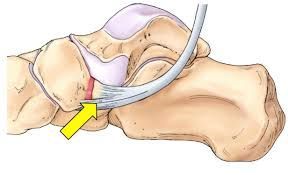 Navicular acessório