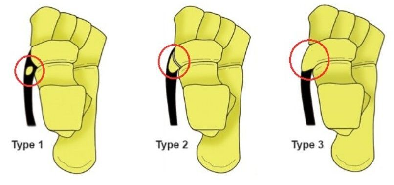 tipos de Navicular acessório