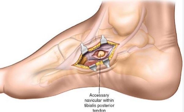 cirurgia Navicular acessório