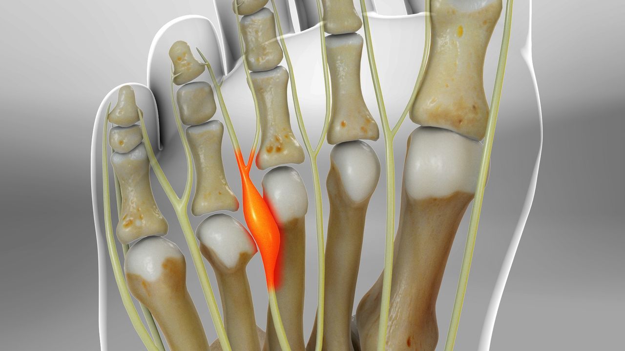 Neuroma de Morton