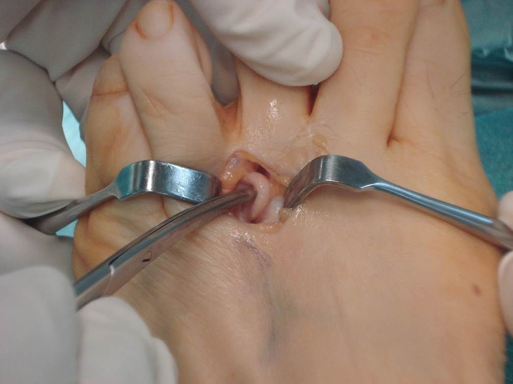 cirurgia neuroma de morton