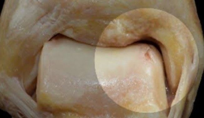 Lesão Osteocondral no Tornozelo