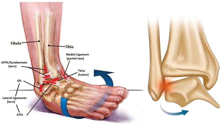 Lesão Osteocondral no Tornozelo