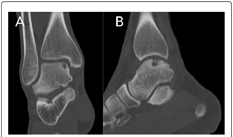 Lesão Osteocondral no Tornozelo