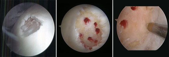Lesão Osteocondral no Tornozelo