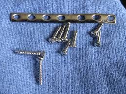 Remoção de Placas e Parafusos Após Fratura do Tornozelo