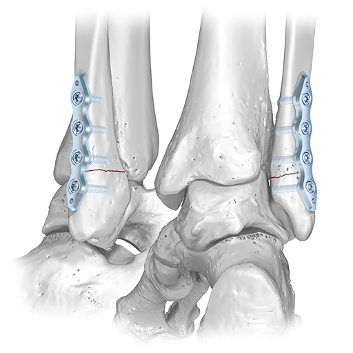 Remoção de Placas e Parafusos Após Fratura do Tornozelo
