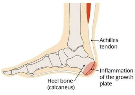 osteocondrite de sever