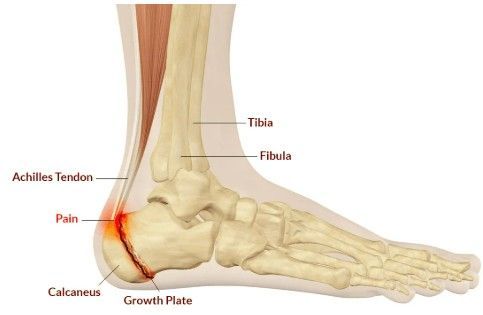 osteocondrite de sever
