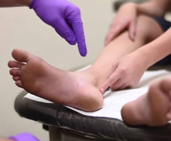 osteocondrite de sever