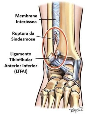 Lesão da Sindesmose no Tornozelo