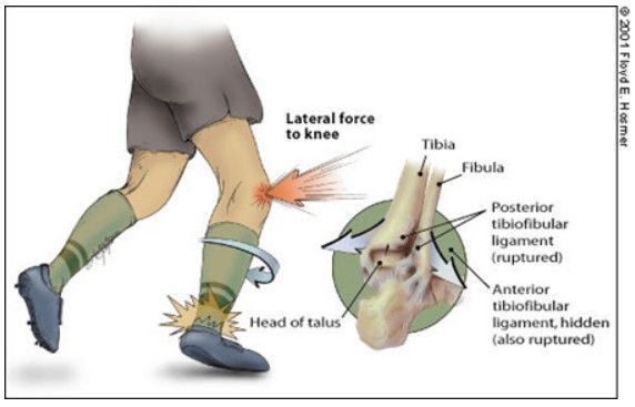 Lesão da Sindesmose no Tornozelo