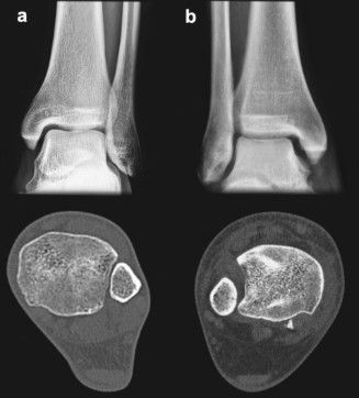 Lesão da Sindesmose no Tornozelo