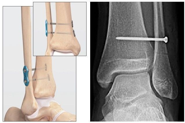 Lesão da Sindesmose no Tornozelo