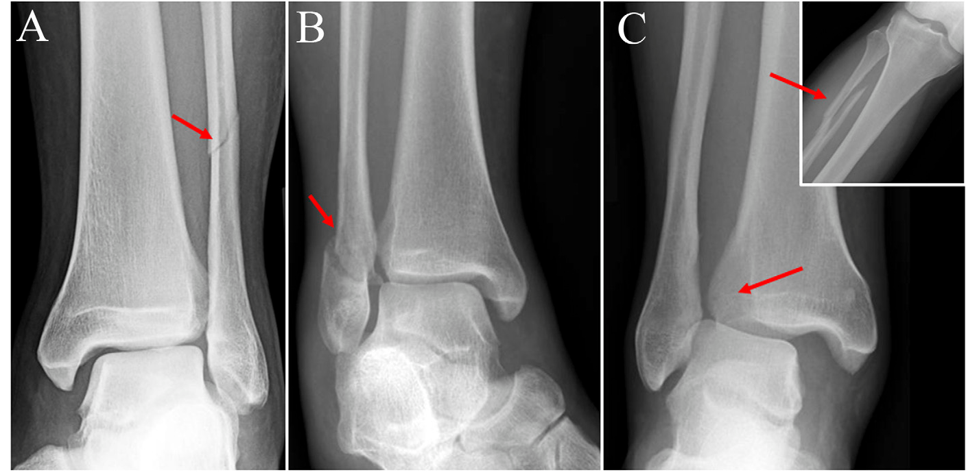 Lesão da Sindesmose no Tornozelo