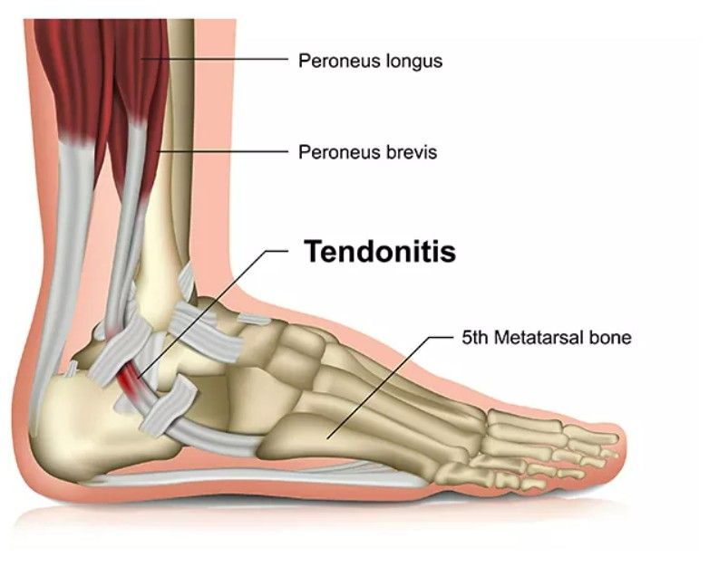 tendinite do tornozelo