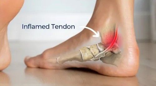 tendinite do tornozelo