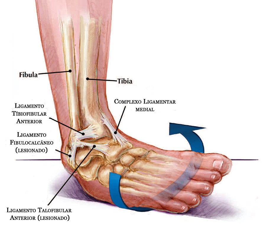 torção de tornozelo e entorse