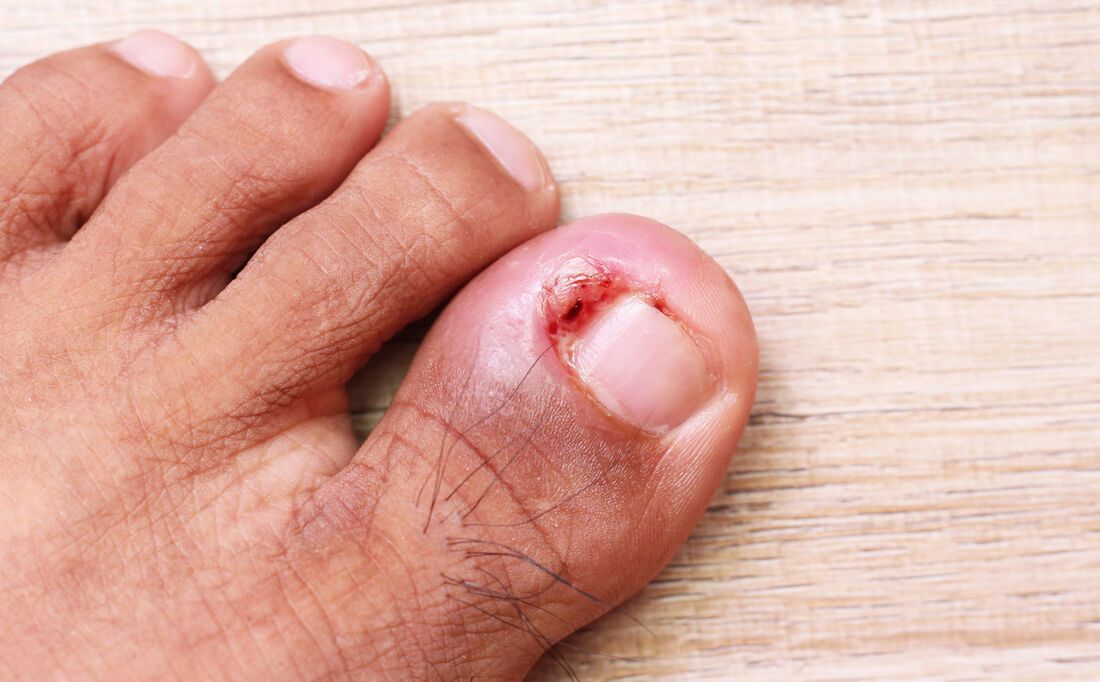Unha encravada? Ortopedista especialista em pé explica causas, sintomas, tratamentos e cirurgia!