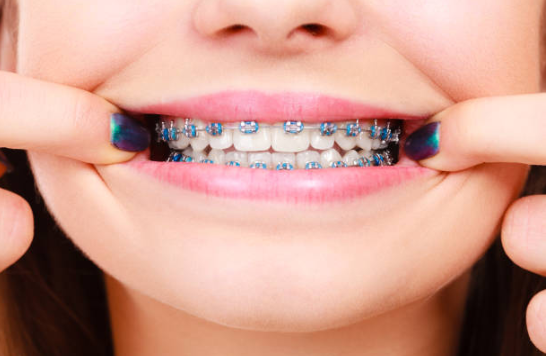 A Smiling Kid with Braces — Boston, MA — Boston Orthodontics