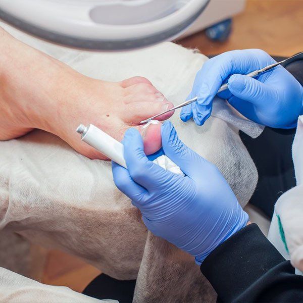 Podiatrist Applying Cream to Toenail — Fungal Nail Treatments in Urunga, NSW