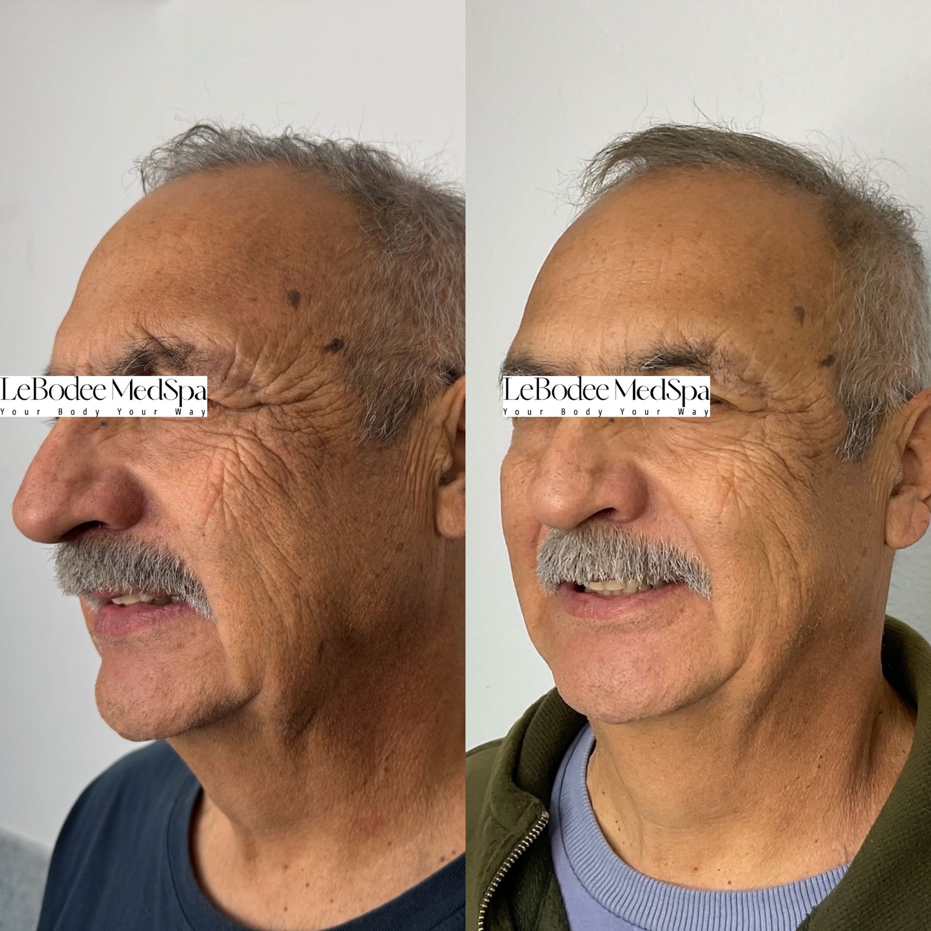 Comparison of a man's face before and after a cosmetic procedure. He has fewer wrinkles after.