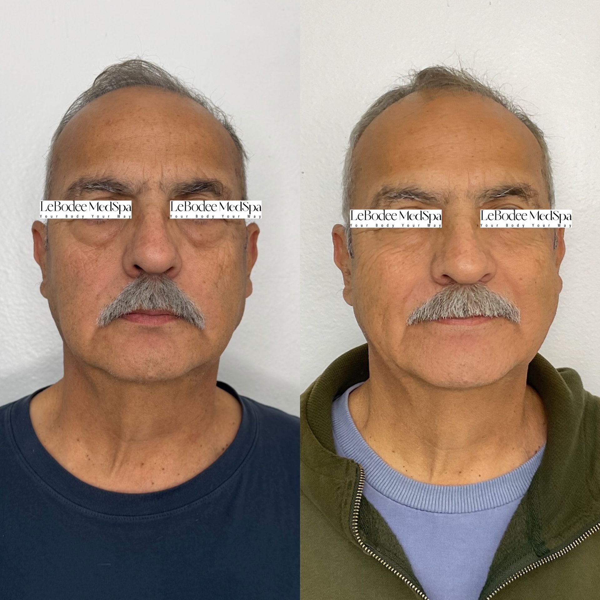A man before and after a procedure. He has dark hair, a mustache, and a slight smile in the after photo.